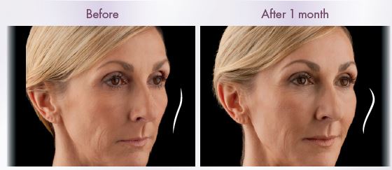Juvederm Voluma - Before and After